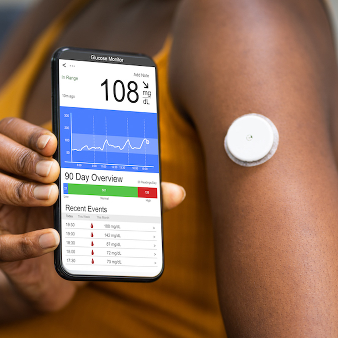 Continuous Glucose Monitoring